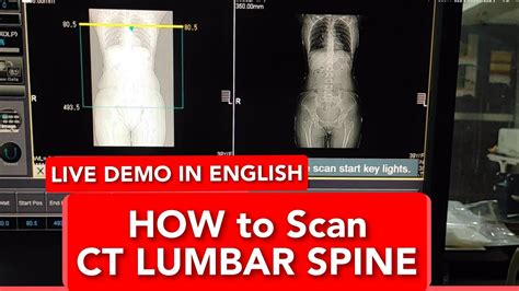 Lumbar Spine CT scan protocol, positioning and planning | Dorso Lumbar Spine | Live Demo in ...