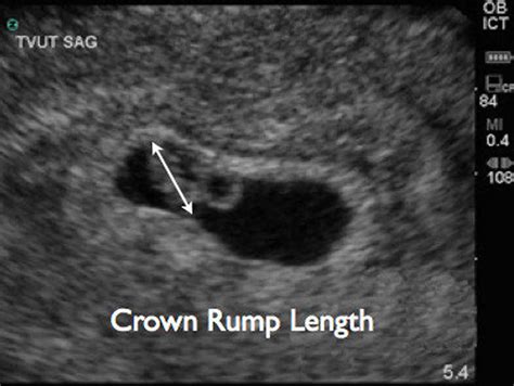 Crown rump length, crown rump length measurement & crown rump length for gestational age