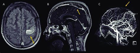 MRI of the brain of a fifteen-year-old patient with acute lymphoblastic... | Download Scientific ...