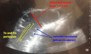 emDOCs.net – Emergency Medicine EducationUS Probe: Ultrasound for Small Bowel Obstruction ...