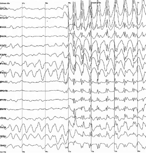 Epilepsy classification - wikidoc