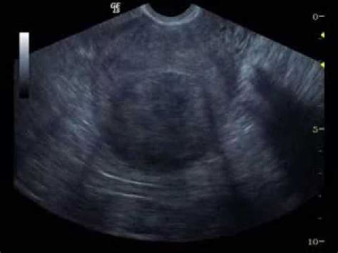 Myoma Uteri Ultrasound 1;1 - YouTube