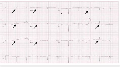 12 leads electrocardiogram (EKG) shows low voltage QRS (black arrows) | Download Scientific Diagram
