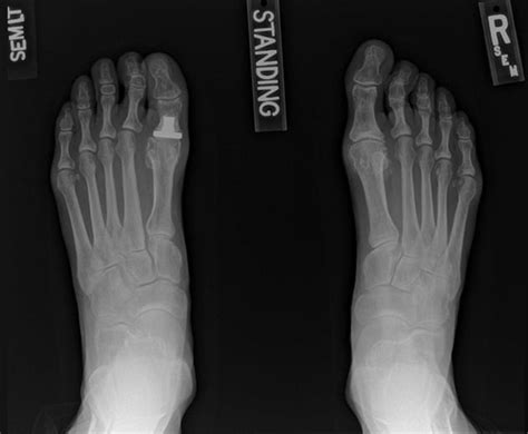 Salvage surgery for failed toe joint replacement - Mayo Clinic