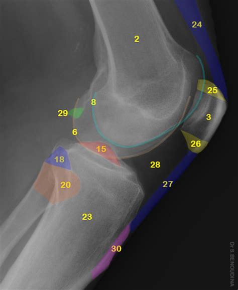 Normal radiographic anatomy of the knee | 2- Distal femoral metaphysis 3- Patella 6- Medial ...