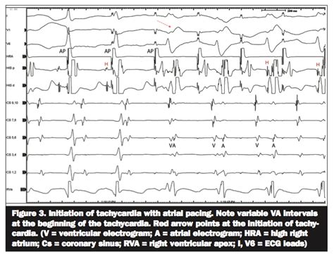 V Tach Ecg Tracings