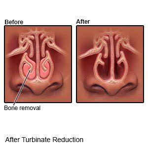 After Turbinate Reduction (Ambulatory Care)