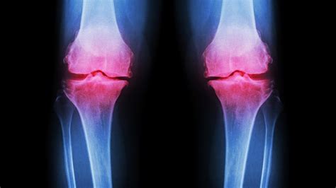 5 Joints Affected by Rheumatoid Arthritis — and How to Care for Them | Everyday Health