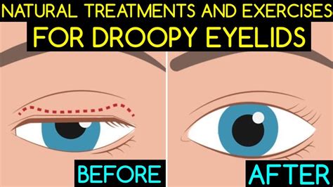 Natural Treatments and Exercises For Droopy Eyelids - YouTube