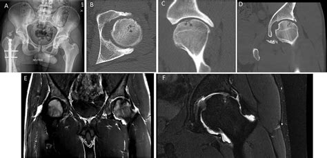 Preoperative imaging demonstrates hip pathology. (A) Anterior/posterior... | Download Scientific ...