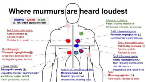 Where murmurs are heard loudest 2nd L intercostal space: Pulmonary stenosis (R) Ejection ...