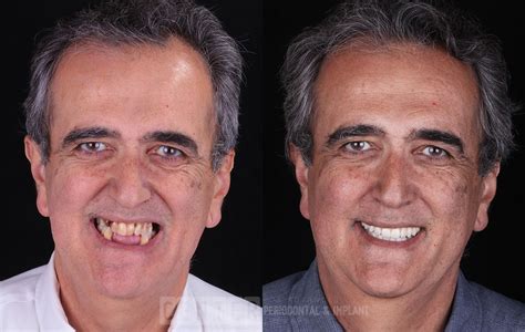 Mejor PELAZO o DIENTAZOS? Calvo VS Dientes Jodidos - Forocoches