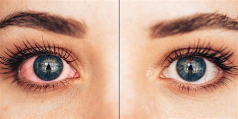 How to Get Rid of Red Eyes | Glasses.com®