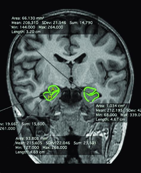 Coronal T1-weighted MP-RAGE sequence on 1.5-T MR scan outlining the... | Download Scientific Diagram