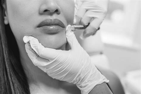 Dermal Filler & Lip Enhancement in Cambridge | Hardwick Clinic | Hardwick Clinic