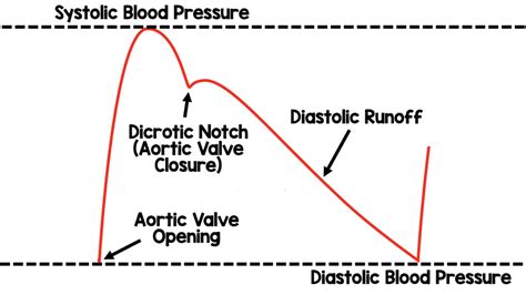 Damping and Arterial Lines - REBEL EM - Emergency Medicine Blog