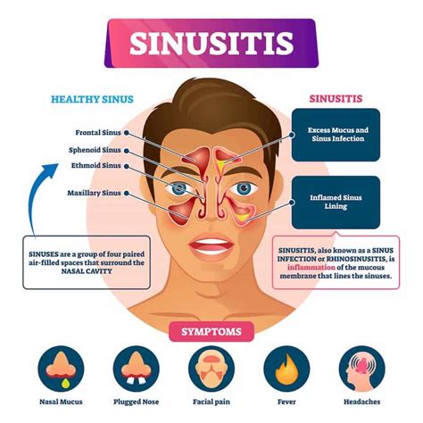 6 Common Symptoms of Chronic Sinusitis To Watch Out For | Sinusitis, Chronic sinusitis, Sinus ...