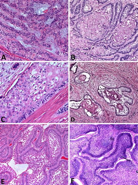 Plexiform Ameloblastoma Histology