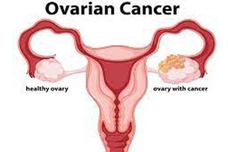 Ovarian Cancer Treatment in India - Causes, Hospitals, FAQs