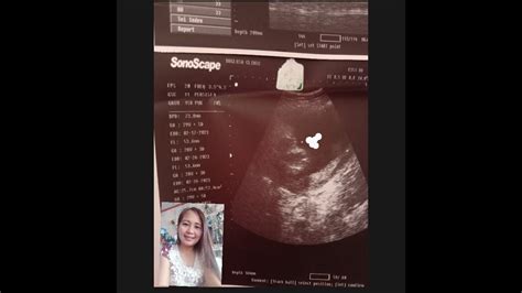 BABY ULTRASOUND and GENDER REVEAL boy or girl - YouTube