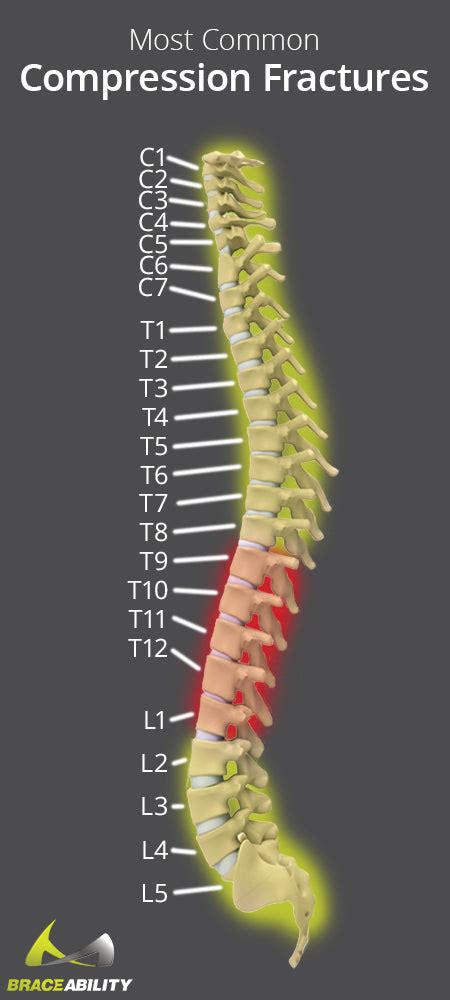 Compression Fracture Treatment, Causes, & Symptoms