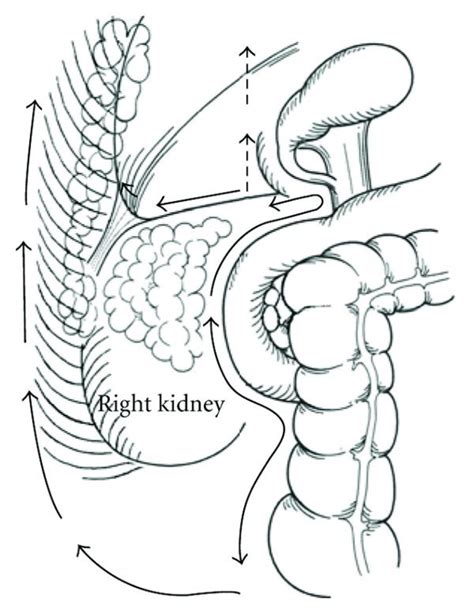 Dissection line of Morrison’s pouch. The peritoneum covering ...