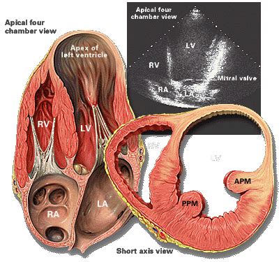 Left ventricular aneurysm | LearntheHeart.com