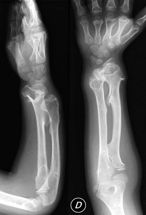 Multiple Exostoses | Radiology Key