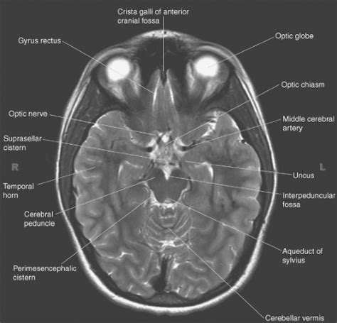 Introduction to Brain Imaging | Radiology Key