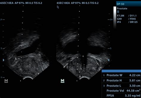 Transrectal ultrasound and prostate biopsy (TRUS Biopsy) — Urology Associates