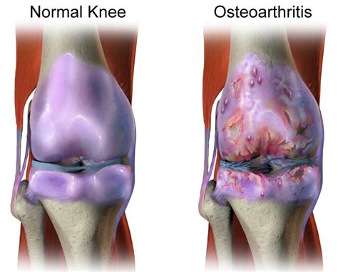 Knee Osteoarthritis - Diagnosis, Treatment & Therapy | Dr. Scott Naftulin