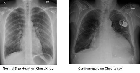 Cardiomegaly On Chest X Ray