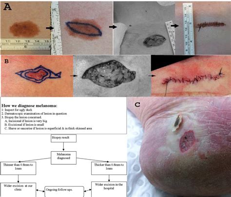 Melanoma - "marsden skin cancer clinic"