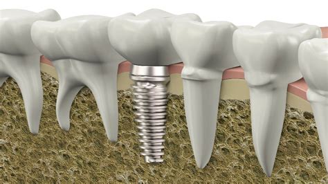 The Process of Getting Fixed Bridges - People Dentist