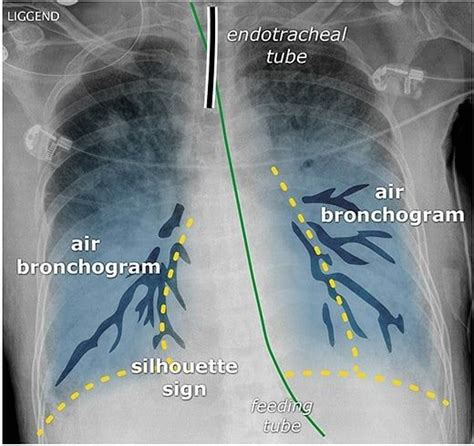 Air bronchograms in bilateral pneumonia. The trachea and the two main bronchi are clearly ...