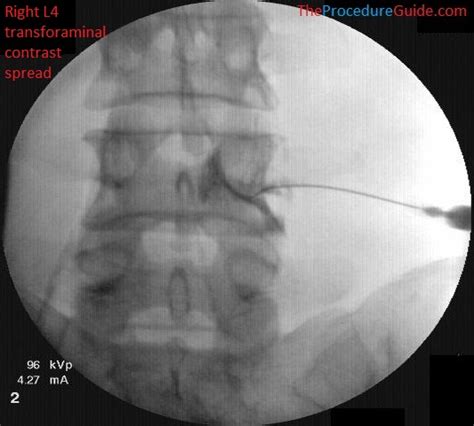 Fluoroscopic Guided Thoracic/Lumbar Transforaminal Epidural Steroid Injection - Technique and ...