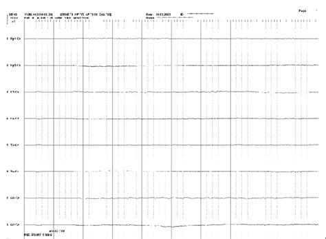 Electroencephalography (EEG) shows the isoelectric line in brain... | Download Scientific Diagram