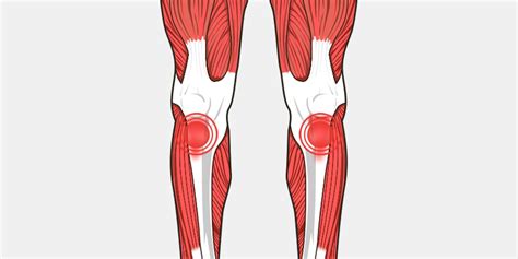 Tendonitis Knee - The Complete Injury Guide - Vive Health