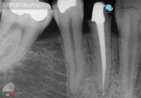 Crown Lengthening Procedure - Styleitaliano.org