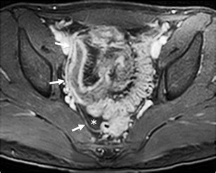 Peritonitis in a 17-year-old girl with Crohn disease who presented with... | Download Scientific ...