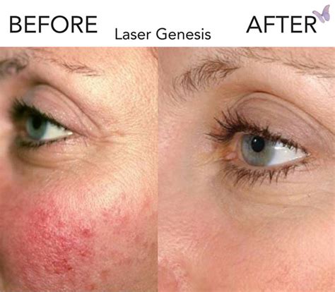 Laser Genesis for Skin Tone | Derma Health Institute