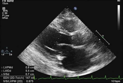 Echocardiographic Assessment of the Patient With Known or Suspected Congestive Heart Failure ...