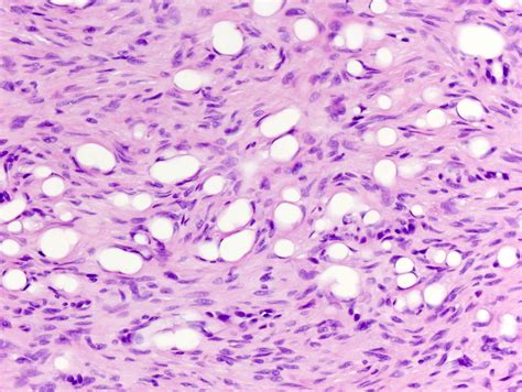 Dermatofibrosarcoma Protuberans | Dermatopathology