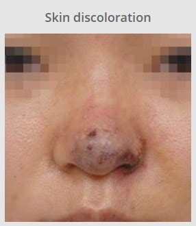 Best nose job clinic in Korea: Skin necrosis after nose filler injection