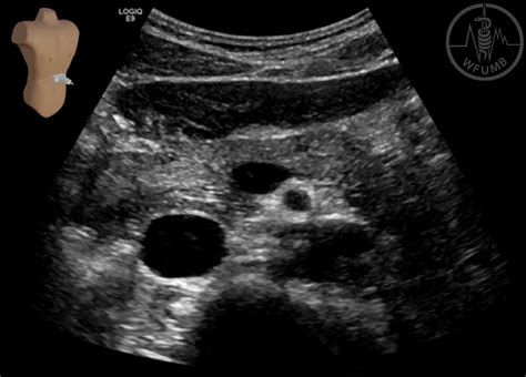 Superior Mesenteric Vein Ultrasound