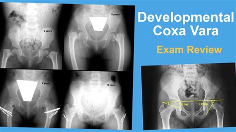 Developmental Coxa Vara Exam Review - Ernie Sink, MD - YouTube