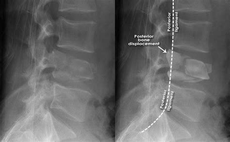 Trauma X-ray - Axial skeleton gallery 2 - Lumbar spine - Burst fracture ...