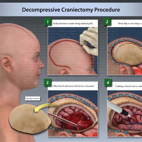 Decompressive Craniectomy Procedure - TrialExhibits Inc.