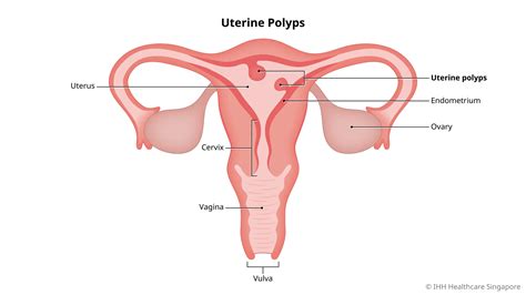 Endometrial (Uterine) Polyps - Causes and Symptoms | Parkway East Hospital