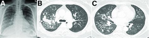 Imaging of 55-year-old immunocompetent woman with human metapneumovirus ...